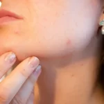 CBD Oils for Skin That Is Prone to Acne